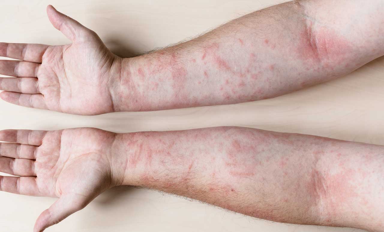 Psoriatic Arthritis